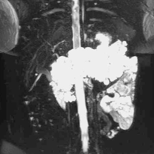 Von Hippel Lindau Disease with Pancreatic Cysts (Von Hippel Lindau - nang tụy)