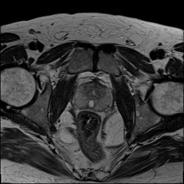Intraprostatic cyst: probable Mullerian duct cyst