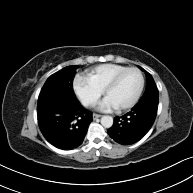 Recurrence of Renal Cell Carcinoma Post Nephrectomy (Tái phát ung thư biểu mô tế bào thận sau cắt bỏ thận)