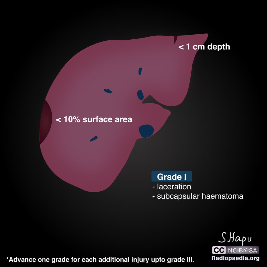 Liver Trauma Grading According to the 2018 AAST Classification (Phân độ chấn thương gan (sơ đồ))