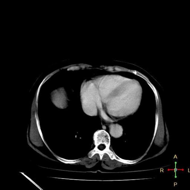 Traumatic Arterio-Portal Fistula Following Radiofrequency Ablation of Hepatocellular Carcinoma (Thông thương động-tĩnh mạch do chấn thương sau đốt điện tần số radio)