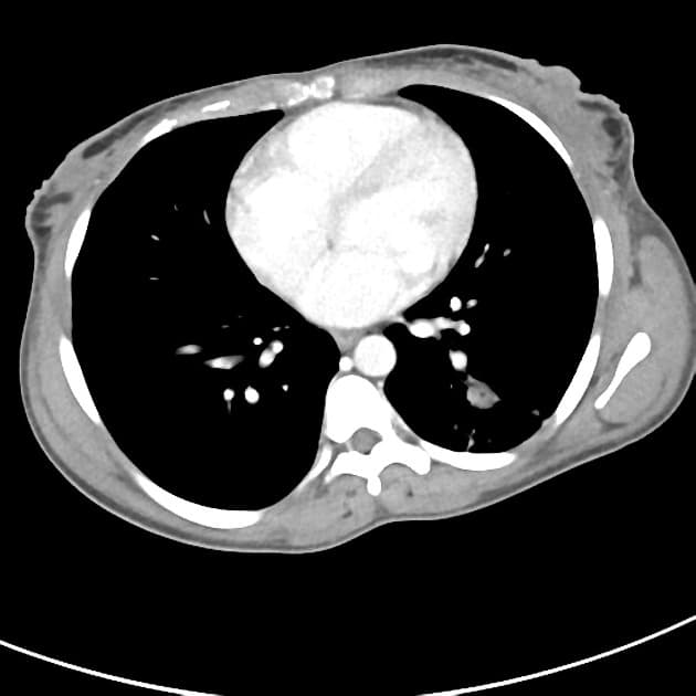 Abdominal tuberculosis and appendicitis