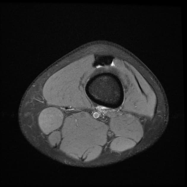 Bucket-Handle Meniscus Tear (Xé dạng xô gánh sụn chêm)