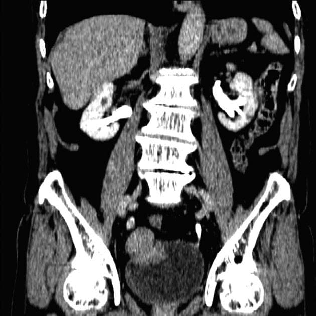 Bladder Carcinoma in a Diverticulum (Ung thư bàng quang trong một túi thừa)