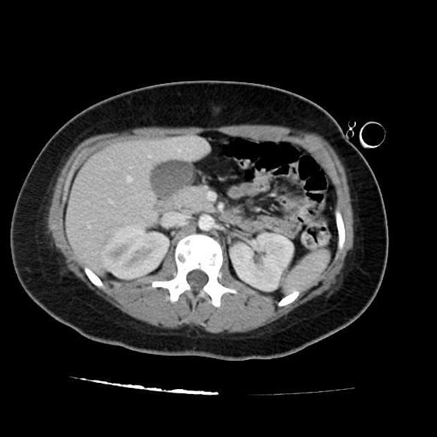 Cardiac Angiosarcoma with Pulmonary Metastases (U ác tính mạch máu tim)
