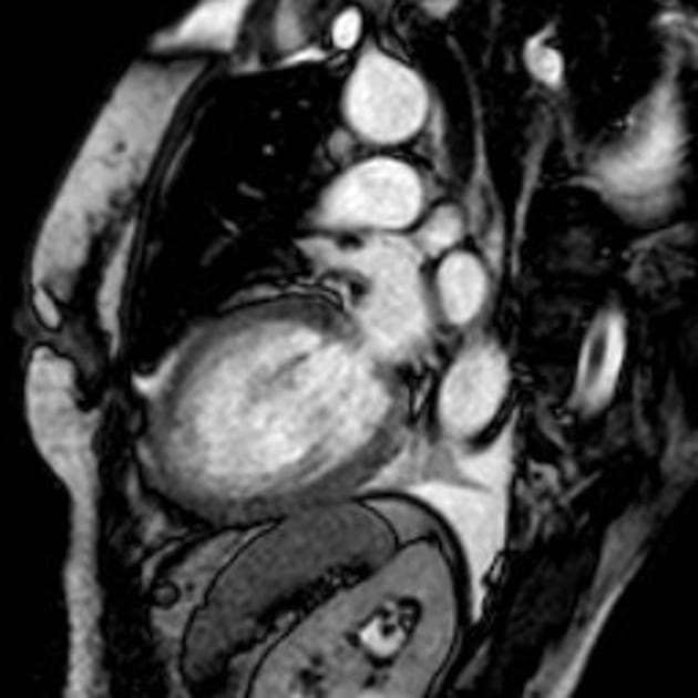 Takotsubo cardiomyopathy