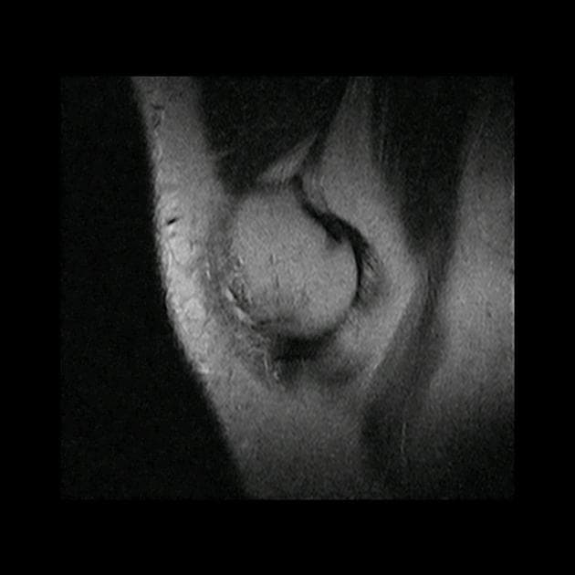 Flipped Meniscus (Tháp mạc hoạt dịch)