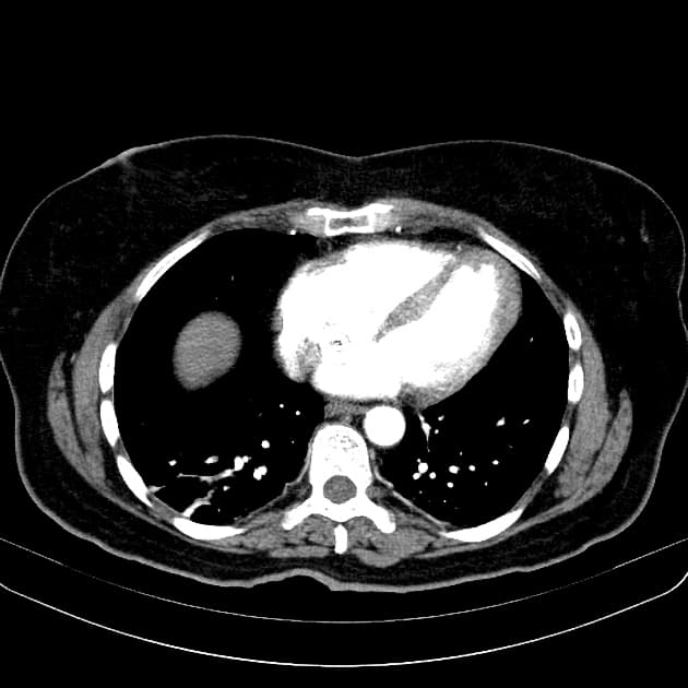 Hepatic adenoma - with spontaneous rupture