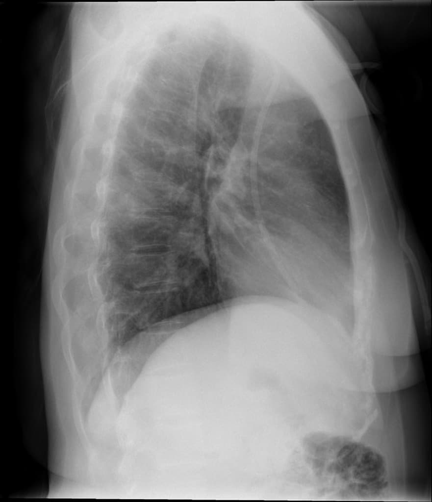 Pulmonary Mucormycosis (Nhiễm nấm Mucor phổi)