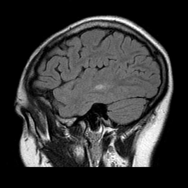 Multiple Sclerosis (Xơ cứng rải rác)