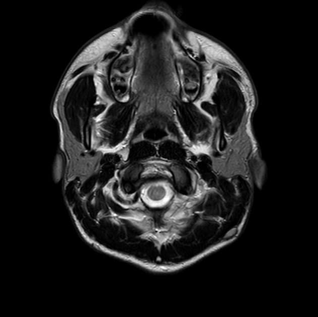 Pediatric Multiple Sclerosis (Xơ cứng rải rác – nhi khoa)