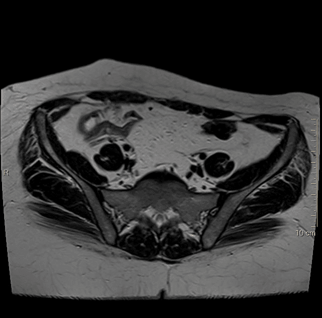 Rectosigmoid endometriosis - mushroom cap sign