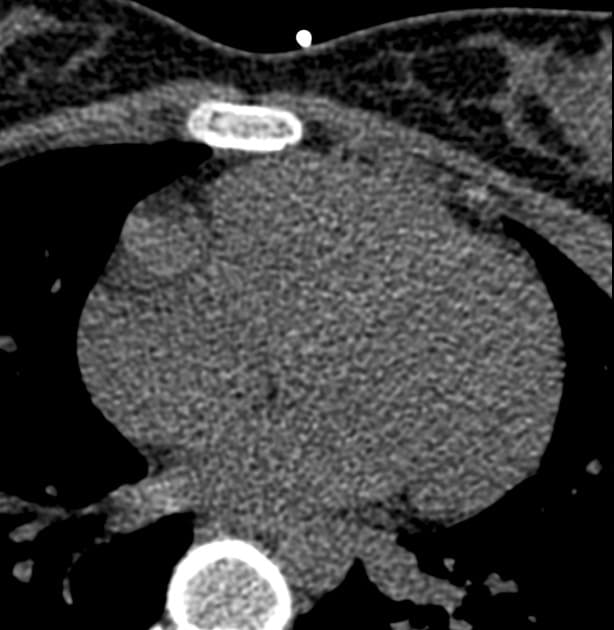Giant Coronary Aneurysms in Kawasaki Disease (Phình mạch vành khổng lồ trong bệnh Kawasaki)
