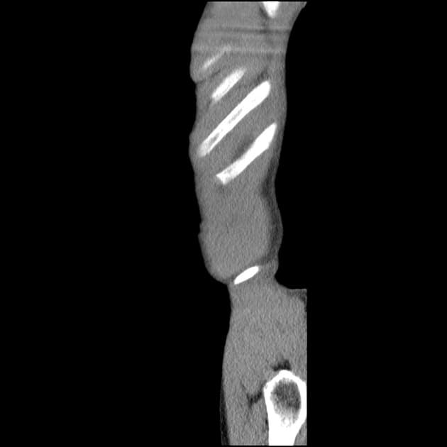 Terminal ileal tuberculosis