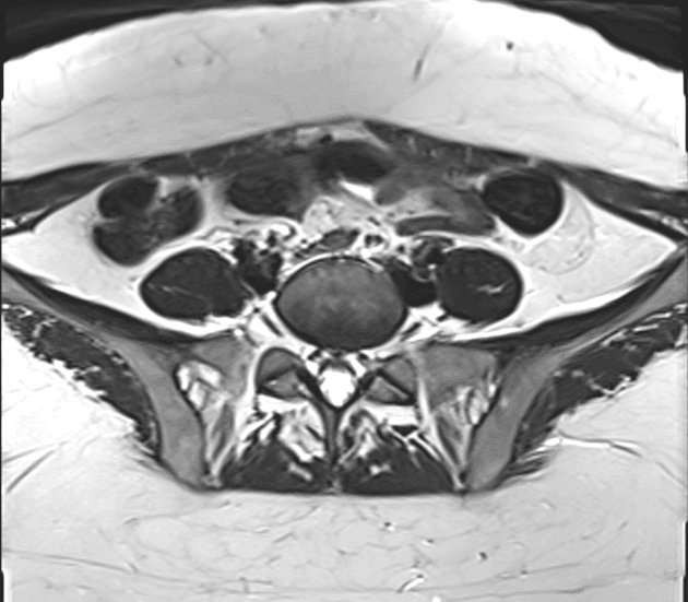 Endometriosis - abdominal wall