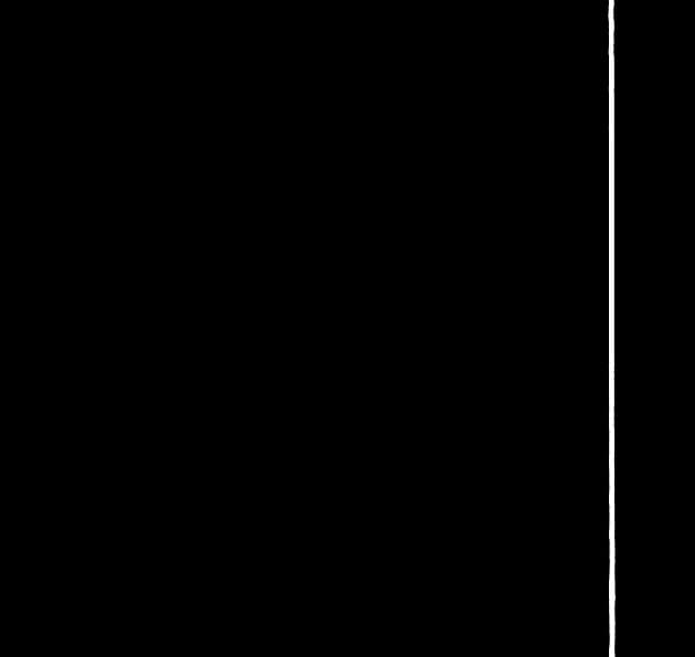 Massive aortic aneurysm, dissection and pericardial effusion