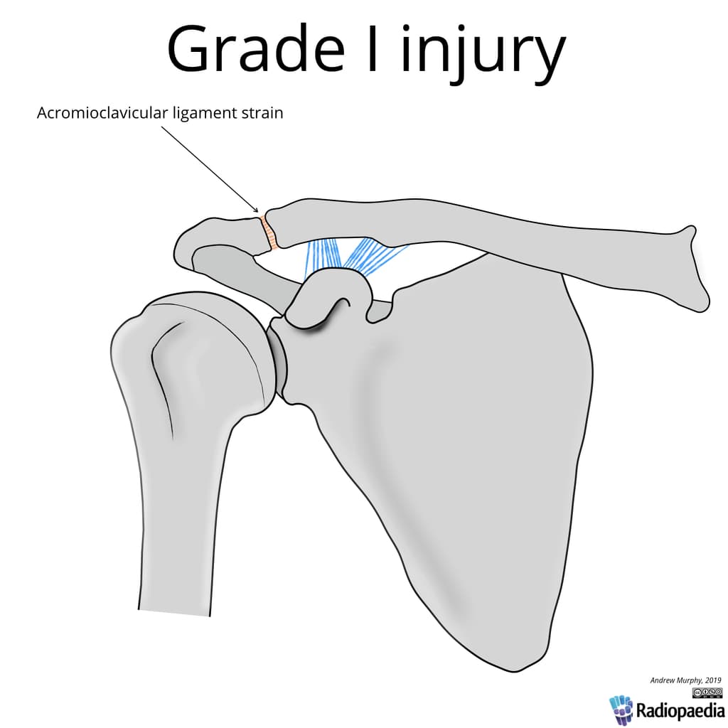 Rockwood Classification of Acromioclavicular Joint Injury (Phân loại Rockwood tổn thương khớp cùng vận động)