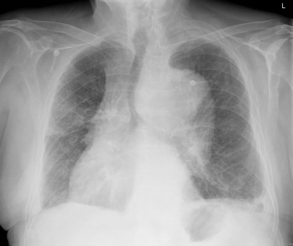 Large thoracic aortic aneurysm