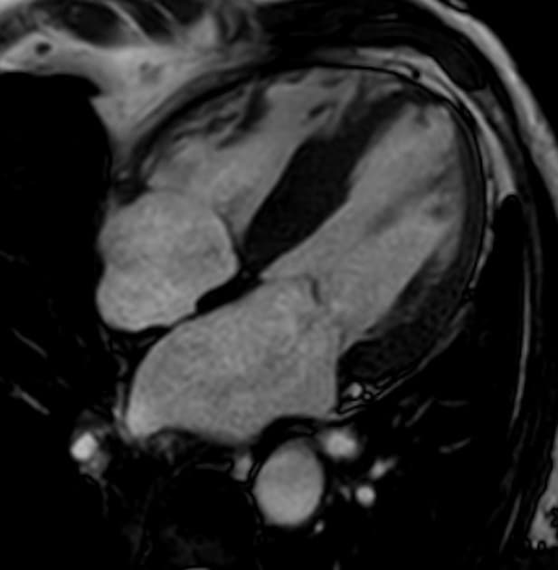 Cardiac amyloidosis - ATTR wild-type