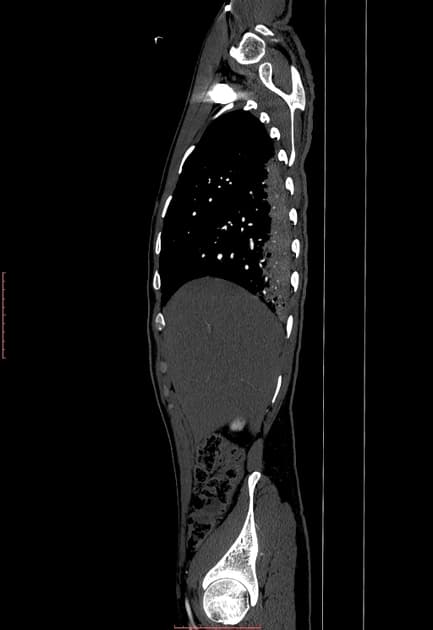 Type A aortic dissection