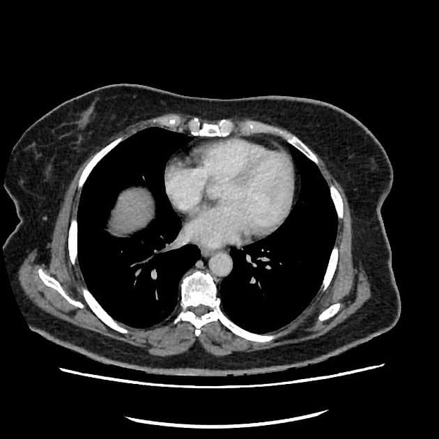 Unresectable Pancreatic Ductal Adenocarcinoma with Celiac Axis Involvement (Ung thư biểu mô ống tụy - không cắt bỏ được)