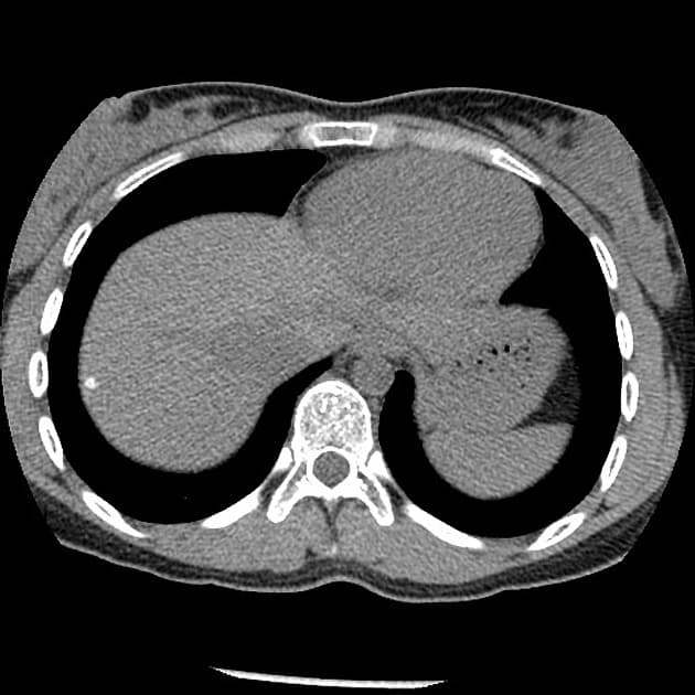 Von Hippel-Lindau Disease with Bilateral Pheochromocytomas and Pancreatic Neuroendocrine Tumor (Bệnh Von Hippel-Lindau - pheochromocytoma hai bên)