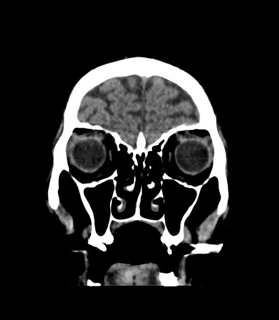 Methanol Induced Encephalopathy (Bệnh não do methanol)