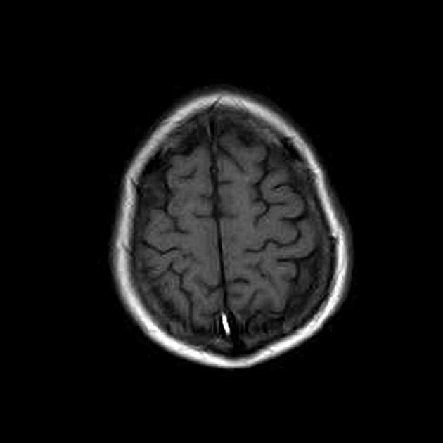 Glioblastoma involving splenium of corpus callosum