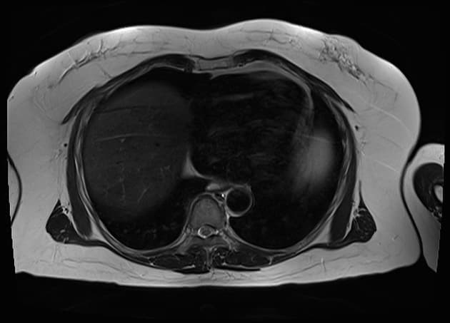 Pancreatic Adenocarcinoma - Borderline Resectable (Ung thư biểu mô tuyến tụy - có thể cắt bỏ được ở mức giới hạn)