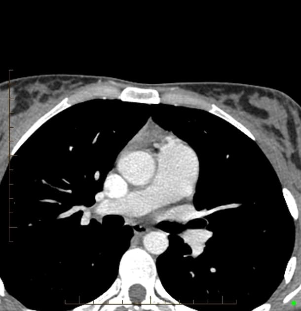 Cardiac Paraganglioma (U ác tế bào đệm tim)