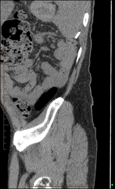 Pathological Vertebral Fracture Due to Metastatic Renal Cell Carcinoma (Gãy xương đốt sống bệnh lý)