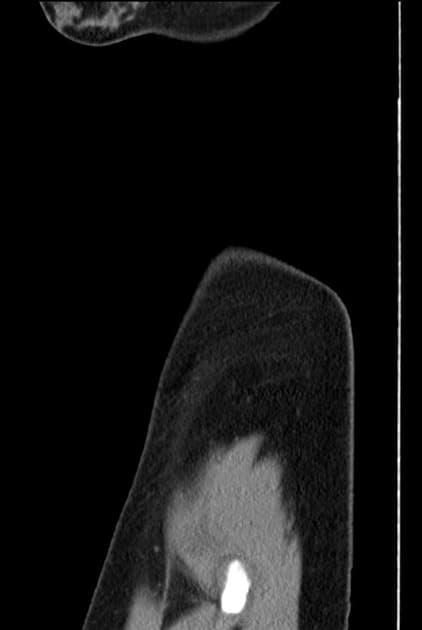 Deep infiltrating endometriosis - rectovaginal