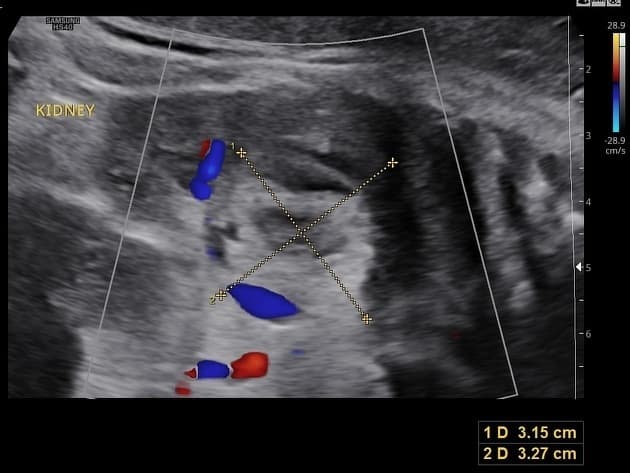 Fetal Neuroblastoma (U nguyên bào thần kinh bào thai)