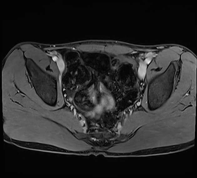 Mullerian duct cyst