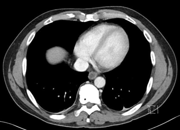 J-pouch procedure - Crohn disease