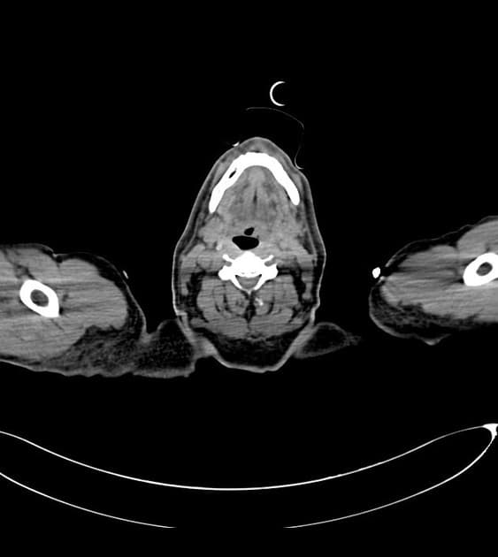 Stanford type B aortic dissection