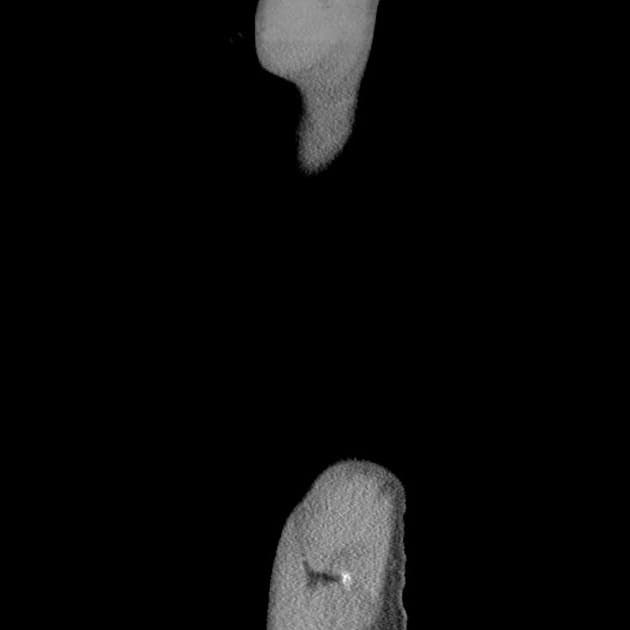 Small bowel obstruction - active Crohn disease