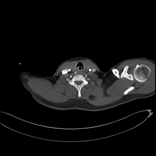 Minimal aortic injury