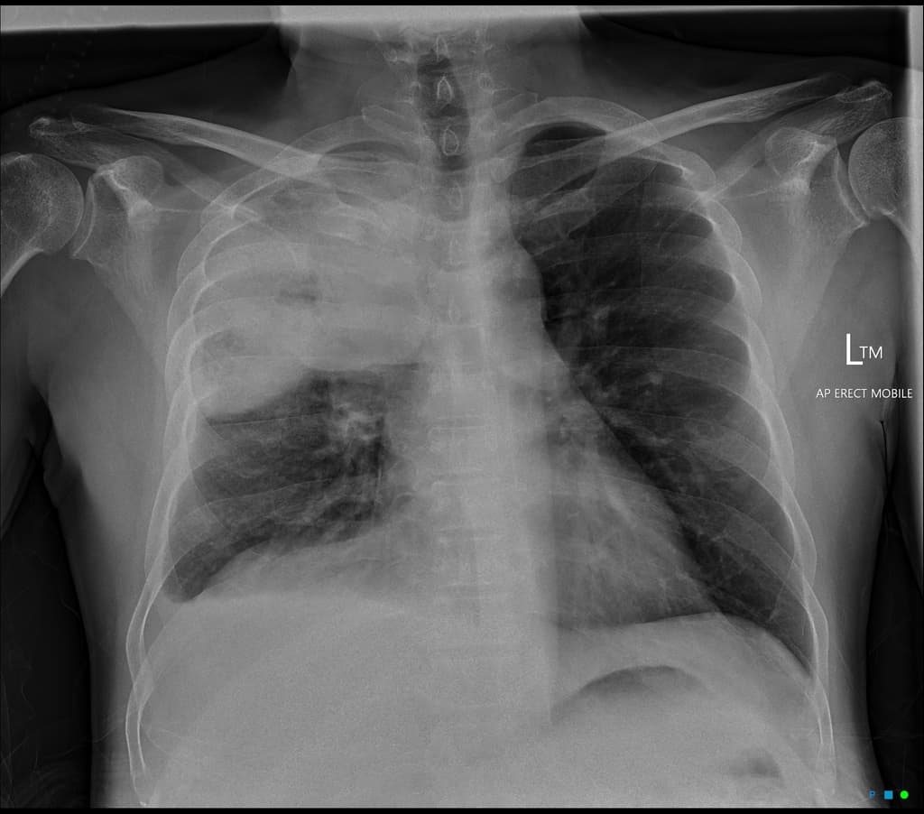 Klebsiella Pneumonia Causing a Bulging Fissure (Viêm phổi Klebsiella gây phồng rãnh liên thùy)