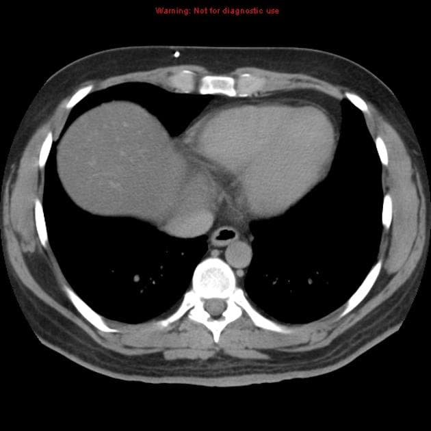 von Hippel-Lindau Disease with Renal and Pancreatic Manifestations (bệnh von Hippel-Lindau (vHL))