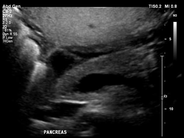 Diffuse Hepatic Steatosis - Grade III (Thoái hóa mỡ gan lan tỏa - độ III)