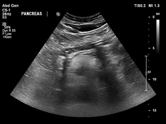 Diffuse Hepatic Steatosis - Grade I (Thoái hóa mỡ gan lan tỏa - độ I)