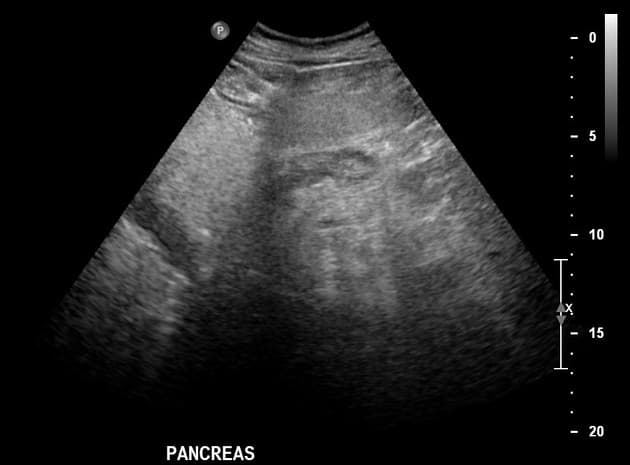 Diffuse Hepatic Steatosis - Grade III (Thoái hóa mỡ gan lan tỏa - độ III)