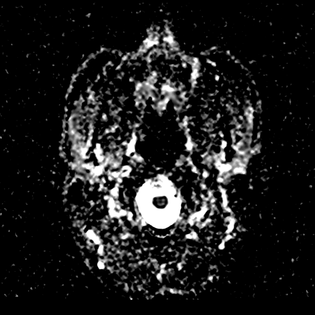 Cerebral Abscesses due to Streptococcus intermedius (Áp xe não (cerebral abscesses))