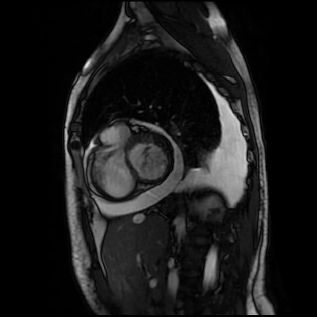 Midventricular hypertrophic cardiomyopathy