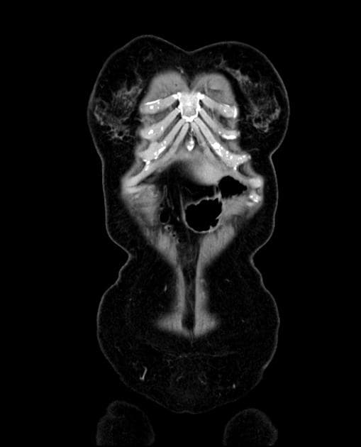 Gastric Cancer with Signet Ring Cell Histology (Ung thư dạ dày)