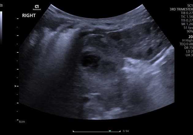 Neonatal Neuroblastoma (U nguyên bào thần kinh sơ sinh)