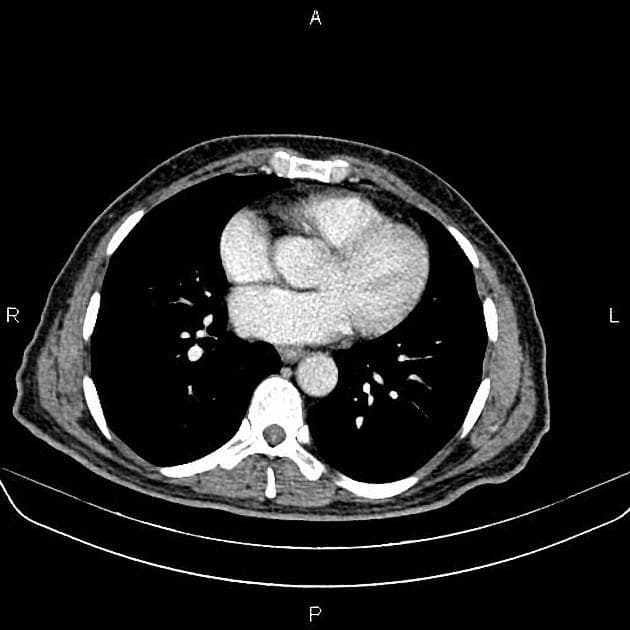 Cholangiocarcinoma (Ung thư tế bào gan đường mật)