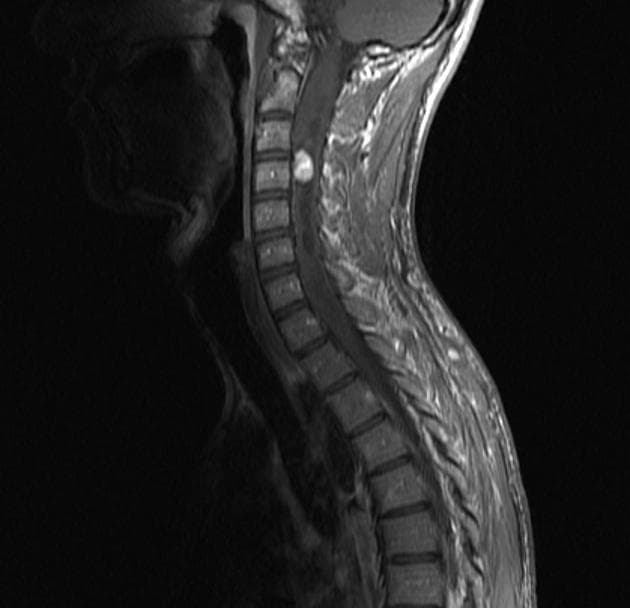Von Hippel-Lindau Disease with Spinal Hemangioblastoma (Bệnh Von Hippel-Lindau với u mạch bào ở tủy sống)