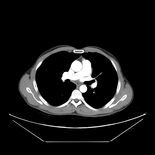 Pancreatic Adenocarcinoma Arising in the Setting of Chronic Pancreatitis (Ung thư biểu mô tuyến tụy trên nền viêm tụy mạn tính)